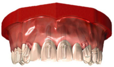 feste Brücke auf Zahnimplantaten