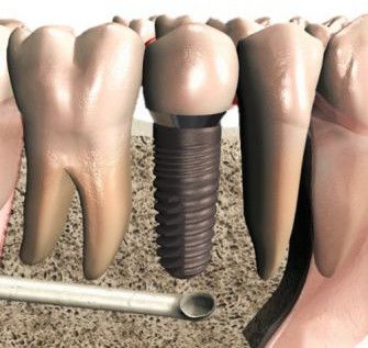 bei einer Zahnimplantation oftmals ein Knochenaufbau erforderlich ist