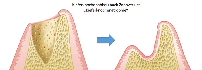 Kieferknochenabbau nach Zahnverlust - Kieferknochenatrophie