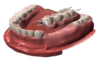 Teilprothese zum Ersatz mehrerer verlorener Zähne.