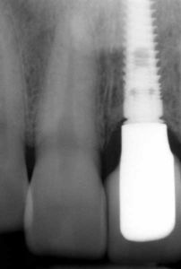 Zahnfilm Digitales Röntgen